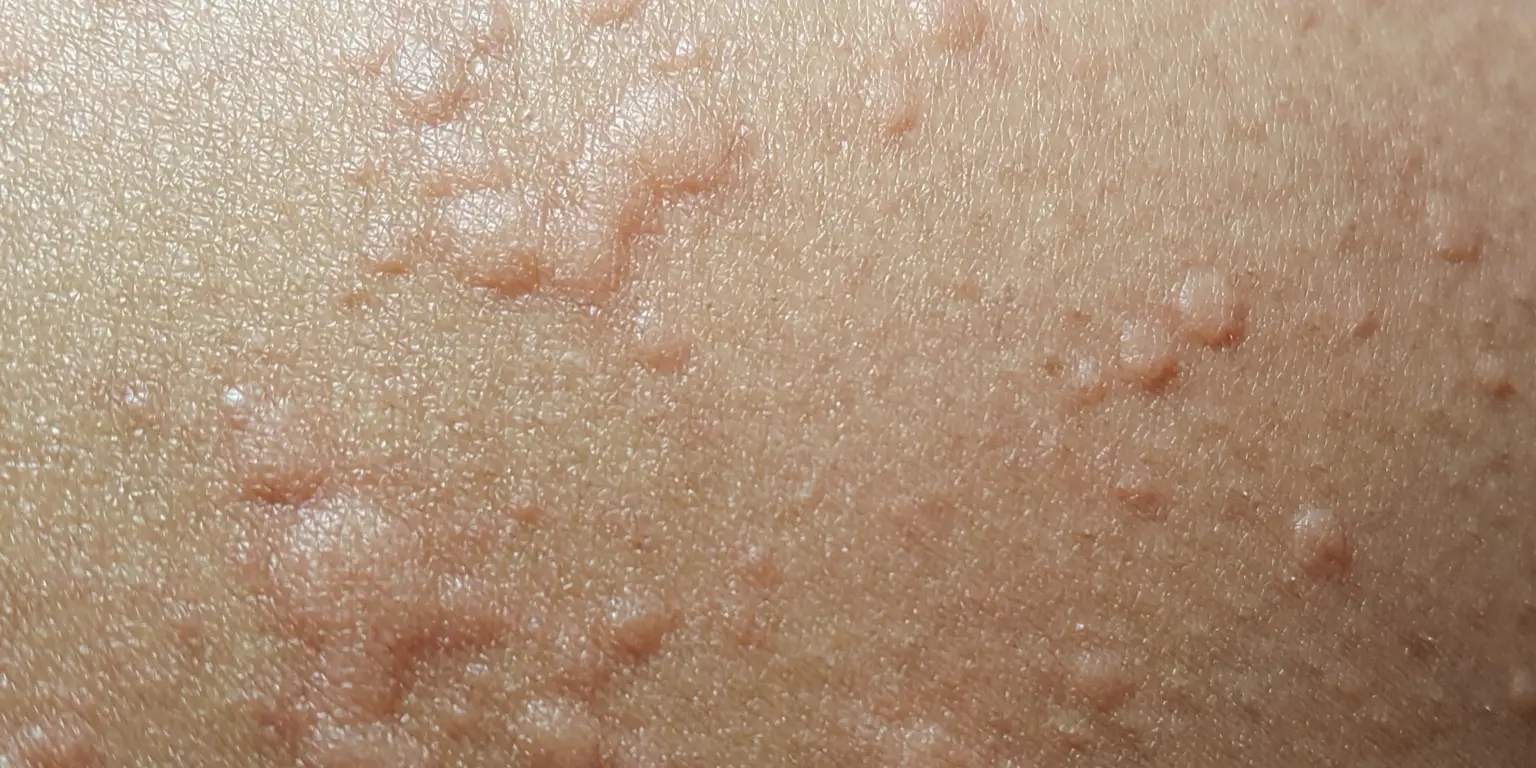 Erupciones cutáneas por COVID-19: Causas, síntomas y tratamiento - Qué es sarpullido con erupción y urticaria erupciones cutaneas por covid - Qué es sarpullido con erupción y urticaria