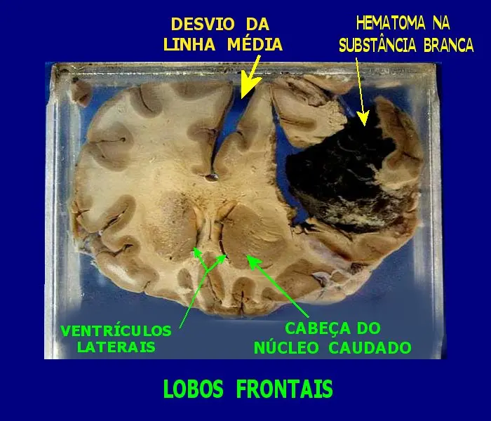 Aneurisma Micótico: Causas, Síntomas y Tratamiento - Qué es un aneurisma en el ojo aneurisma micotico - Qué es un aneurisma en el ojo