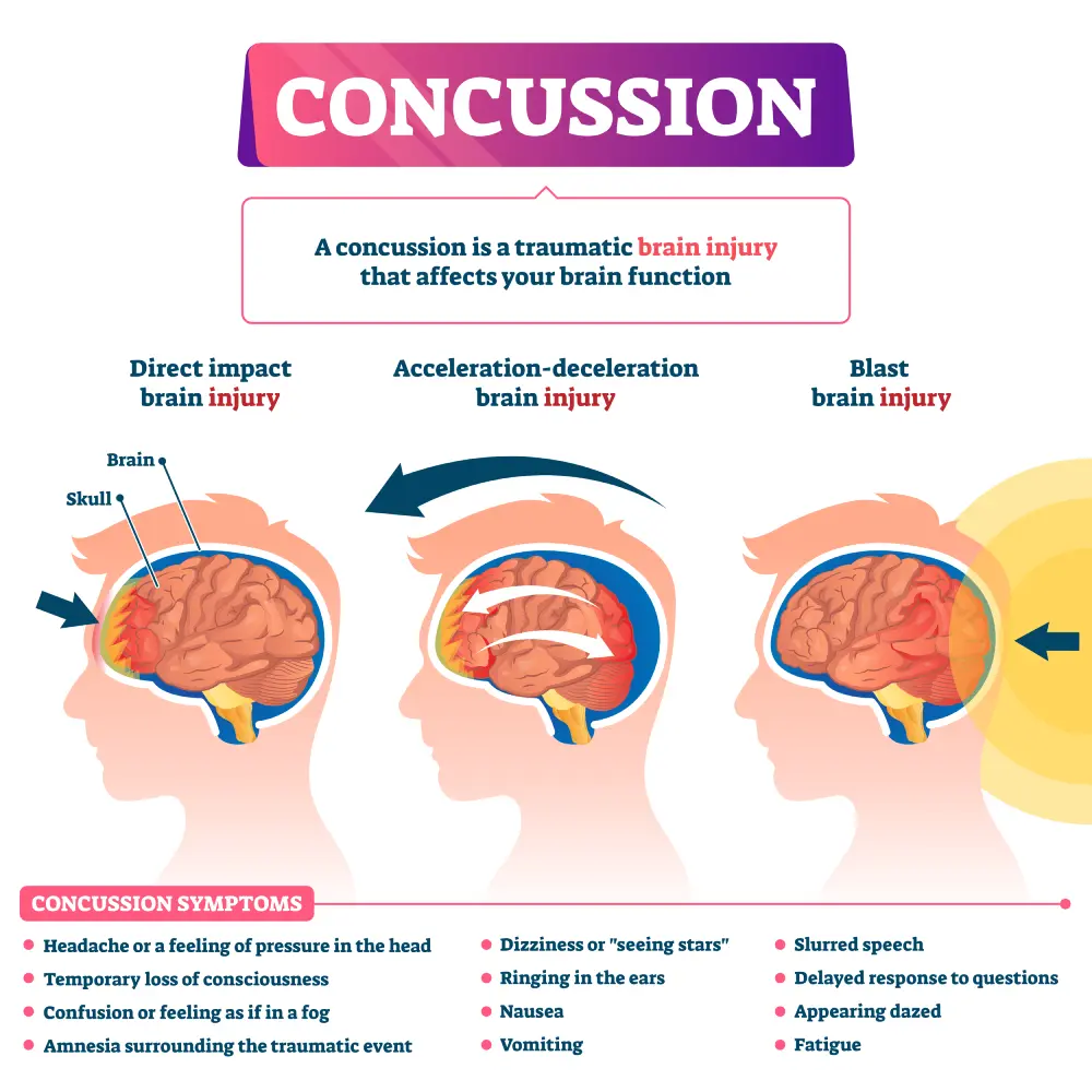 Concusión: Definición, Causas, Síntomas y Tratamiento - Qué es un delito de concusión concusion - Qué es un delito de concusión