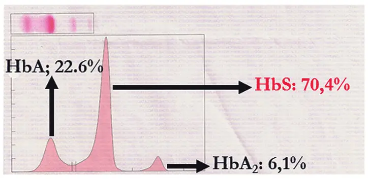 Electroforesis de Hemoglobina: Qué es, para qué sirve y cómo se interpreta - Qué es un examen de electroforesis de hemoglobina electroforesis de hemoglobina - Qué es un examen de electroforesis de hemoglobina