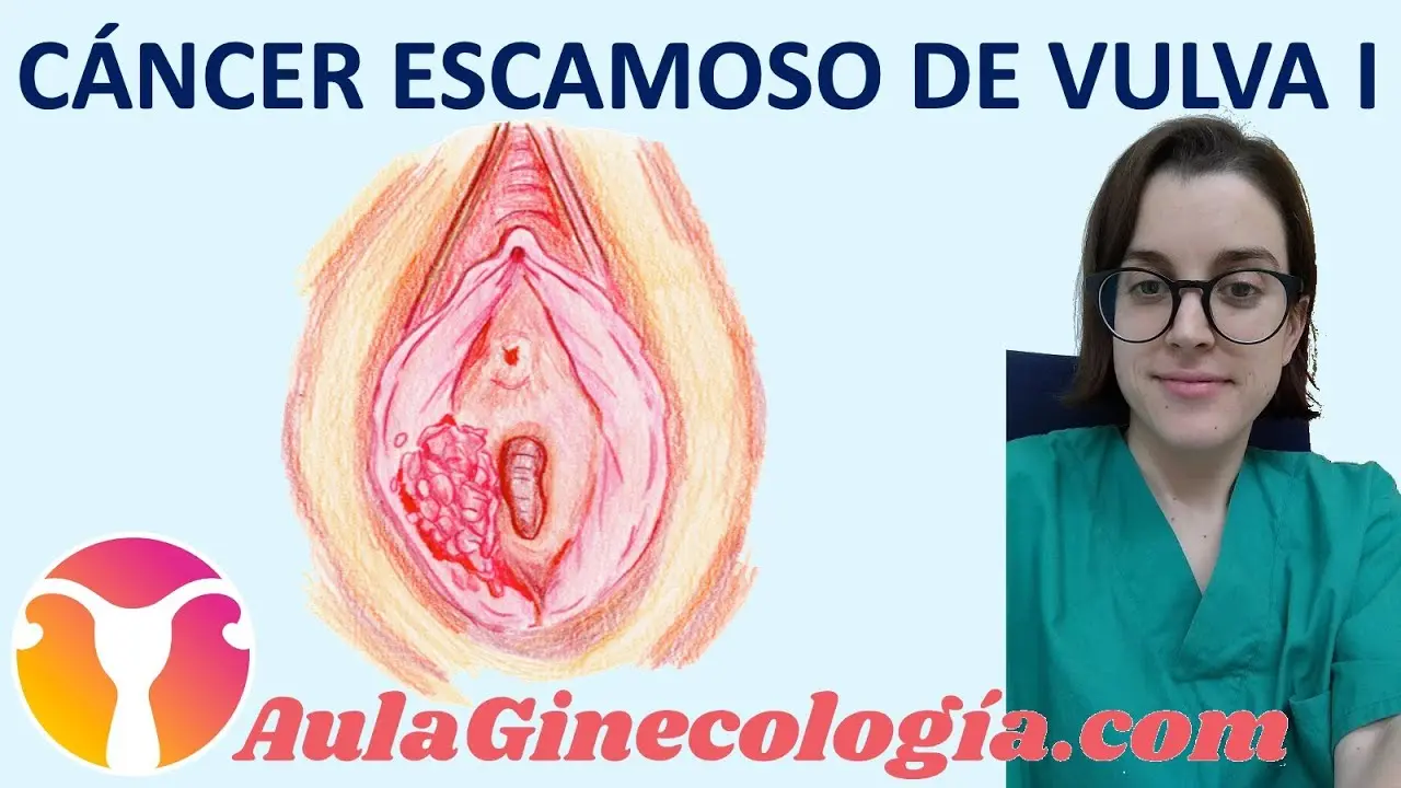 Cáncer Vulvar en Mujeres Jóvenes: Una Mirada a la Realidad - Qué es un melanoma vulvar cancer vulvar en mujeres jovenes - Qué es un melanoma vulvar
