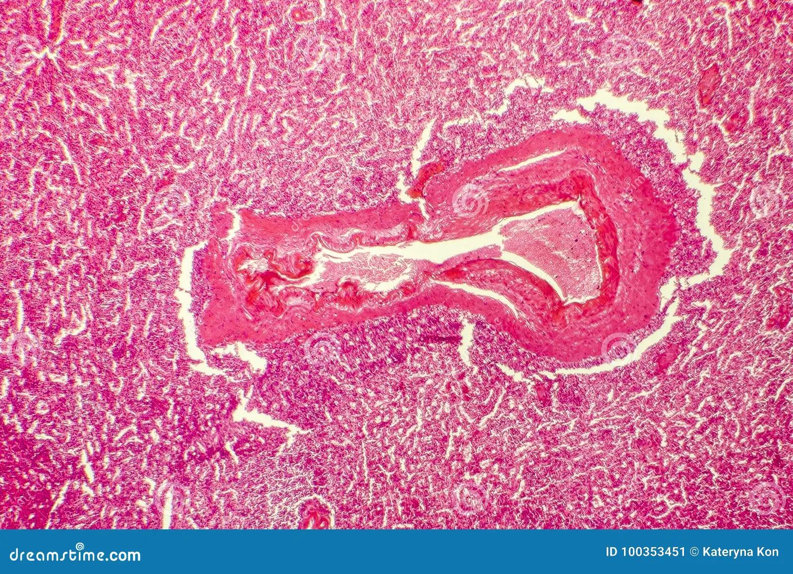 Degeneración Hialina: Un Fenómeno Común en los Leiomiomas Uterinos - Qué es un mioma con degeneración hialina degeneracion hialina - Qué es un mioma con degeneración hialina