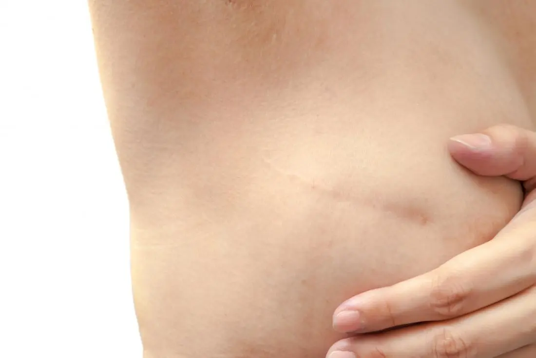 Nódulo Benigno en el Seno: Qué es, Diagnóstico y Tratamiento - Qué es un nódulo benigno en el seno operacion de nodulo en mama - Qué es un nódulo benigno en el seno