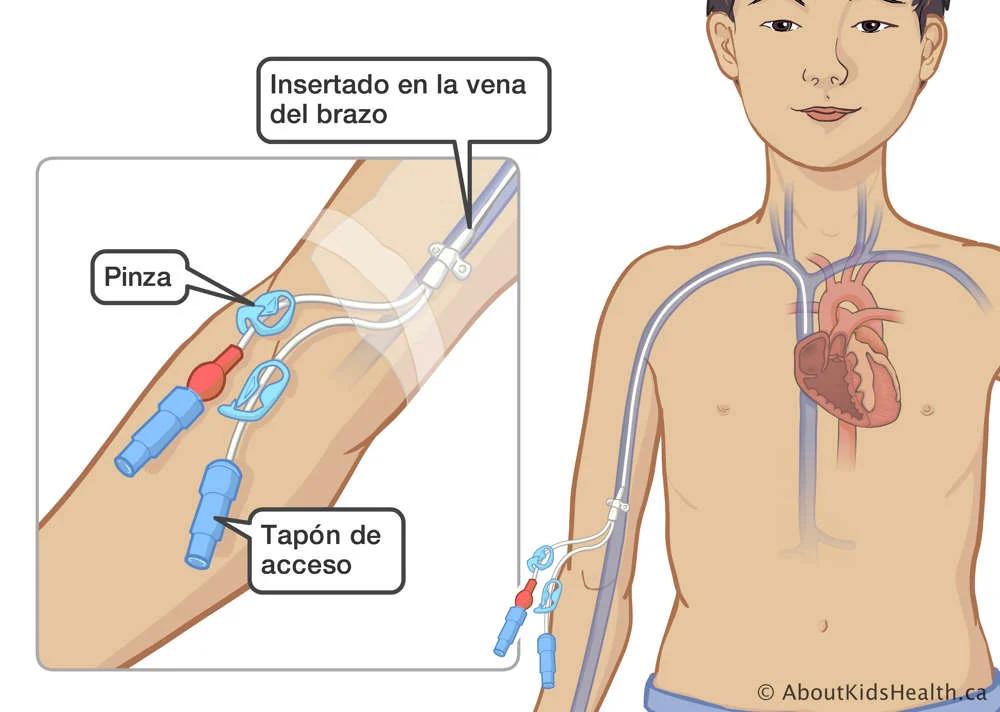 Catéter PICC: Guía Completa para Pacientes - Qué es un PICC y para qué sirve cateter picc - Qué es un PICC y para qué sirve