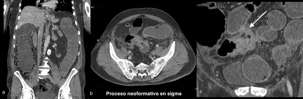 Proceso Neoformativo: Formación y Detección de Tumores - Qué es un proceso neoplásico proceso neoformativo - Qué es un proceso neoplásico