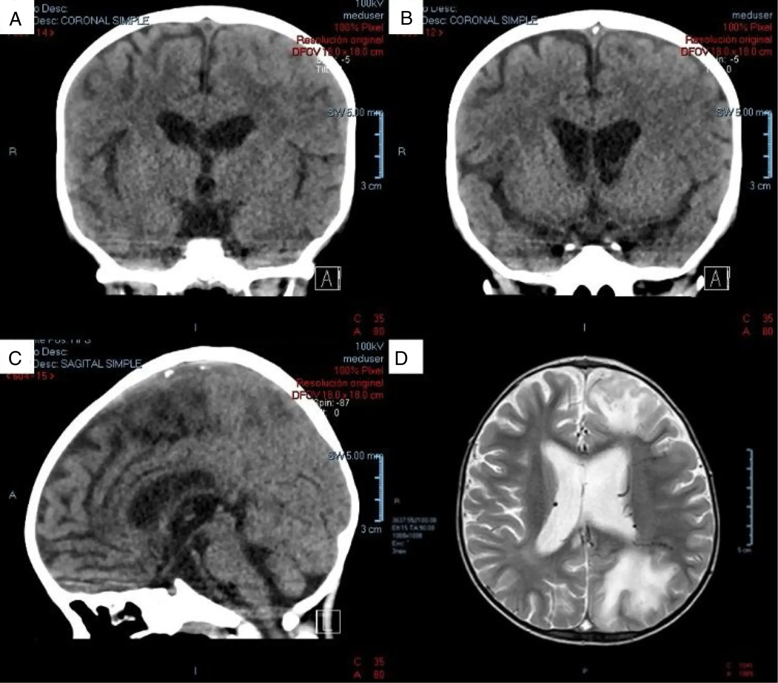 Trombosis del Seno Longitudinal Superior: Una Complicación Grave del Cerebro - Qué es un trombo en el seno trombosis del seno longitudinal superior - Qué es un trombo en el seno