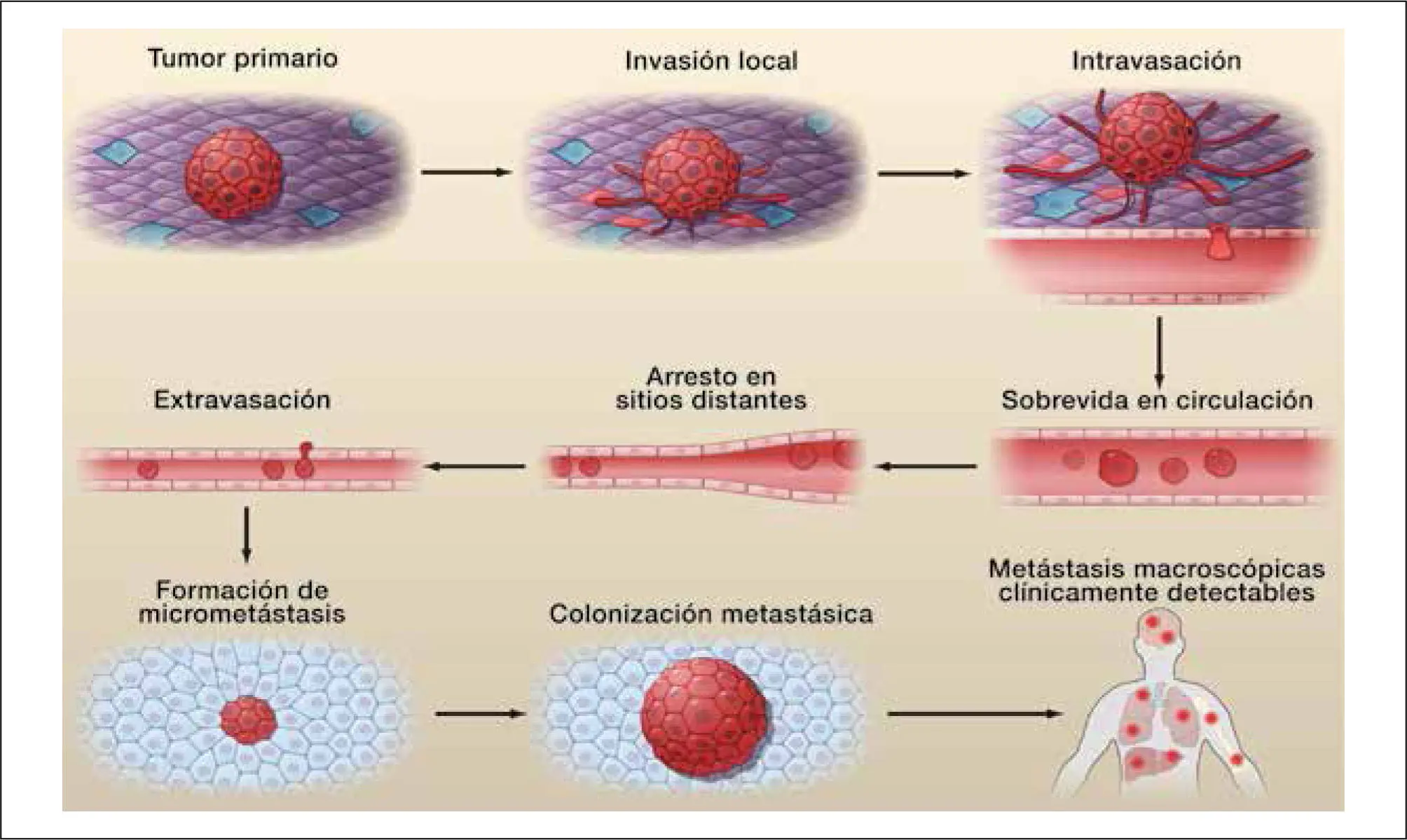 Lesiones Neoproliferativas en la Cavidad Bucal: Un Análisis de Diagnóstico y Frecuencia - Qué es un tumor proliferativo proceso neoproliferativo - Qué es un tumor proliferativo