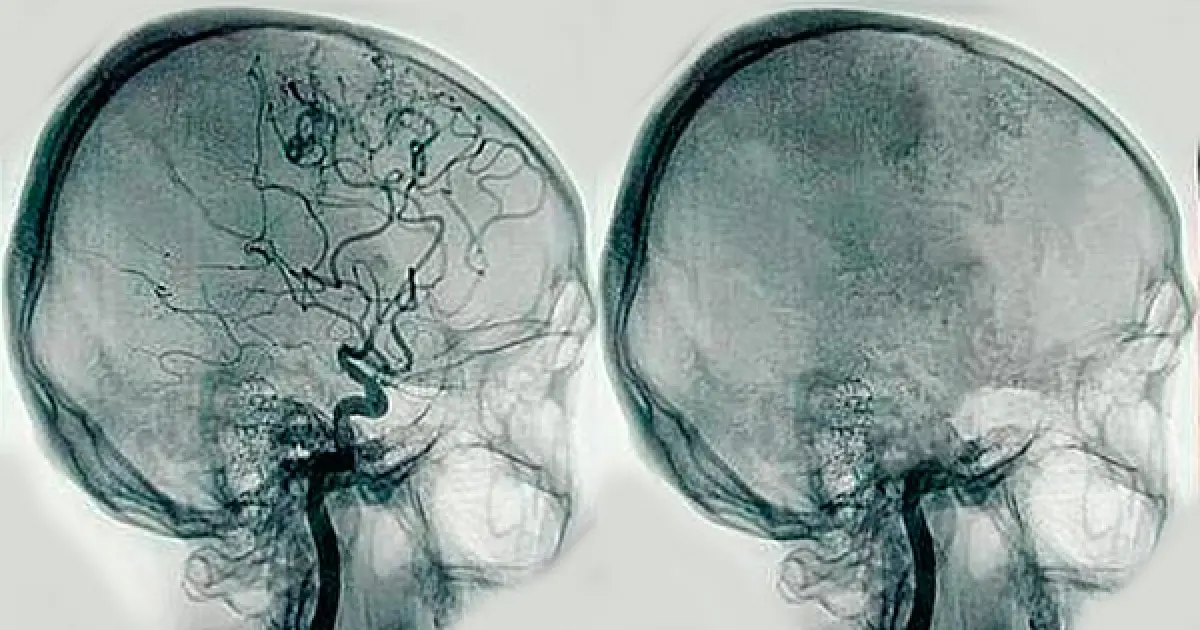 Angiografía: Qué es, cómo se realiza y riesgos asociados - Qué es una angiografía y para qué sirve angiografia - Qué es una angiografía y para qué sirve