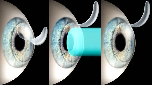 Cirugía Refractiva: Corrección de la Visión con Láser y Lentes Intraoculares - Qué es una consulta refractiva refractiva - Qué es una consulta refractiva