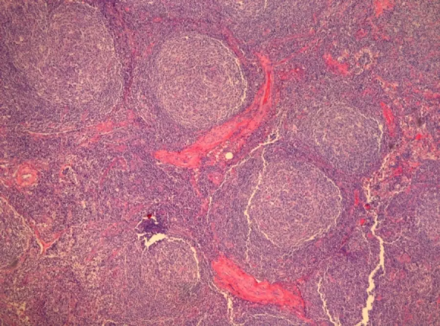 Enfermedad de Castleman: Causas, síntomas, tratamiento y complicaciones - Qué es una enfermedad multicéntrica enfermedad de castleman - Qué es una enfermedad multicéntrica