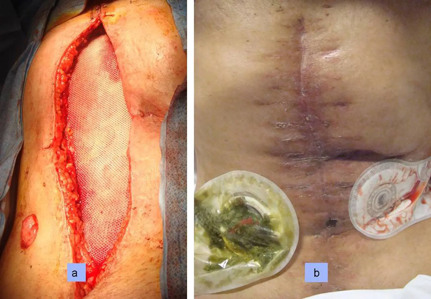 Fístula Enterocutánea: Una Complicación Compleja con Enfoque en el Manejo Nutricional - Qué es una fístula enterica fistula enterocutanea - Qué es una fístula enterica