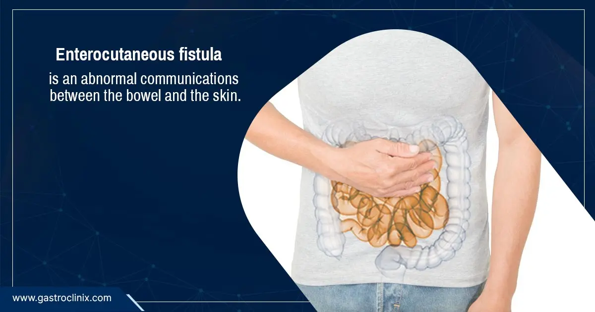 Fístula Enterocutánea: Una Complicación Compleja con Enfoque en el Manejo Nutricional - Qué es una fístula enteroatmosférica fistula enterocutanea - Qué es una fístula enteroatmosférica