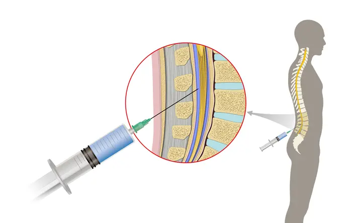Punción Lumbar: Procedimiento, Riesgos y Resultados - Qué es una punción lumbar y para qué sirve puncion lumbar - Qué es una punción lumbar y para qué sirve