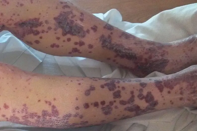 Púrpura de Henoch: Causas, Síntomas y Tratamiento - Qué es una púrpura en la piel alergia purpura - Qué es una púrpura en la piel