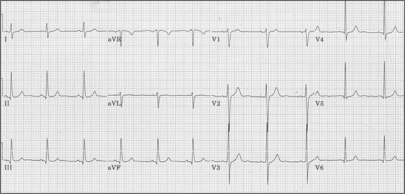 ECG: Una Guía Completa sobre la Señal y su Importancia Médica - Qué es una señal ECG imagen ecg - Qué es una señal ECG