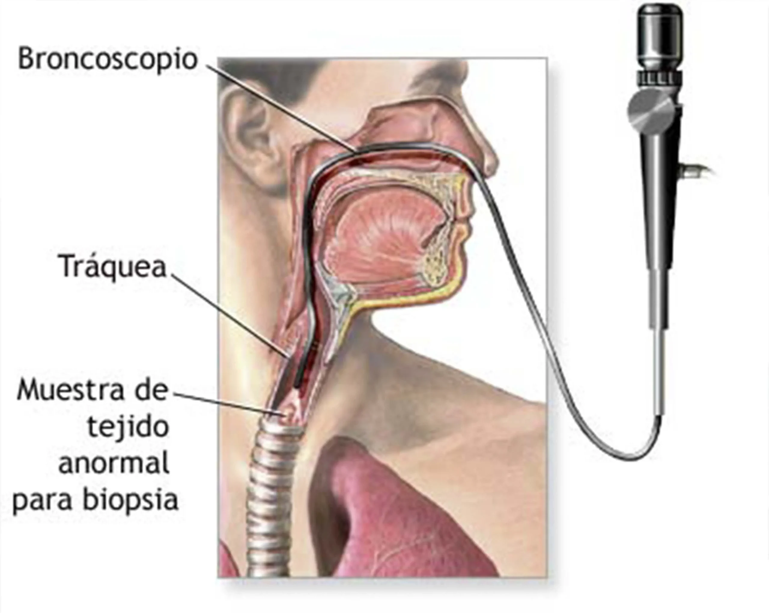 Broncoscopia: Qué es, para qué sirve y cómo se realiza - Qué es y para qué sirve una broncoscopia broncoscopia - Qué es y para qué sirve una broncoscopia