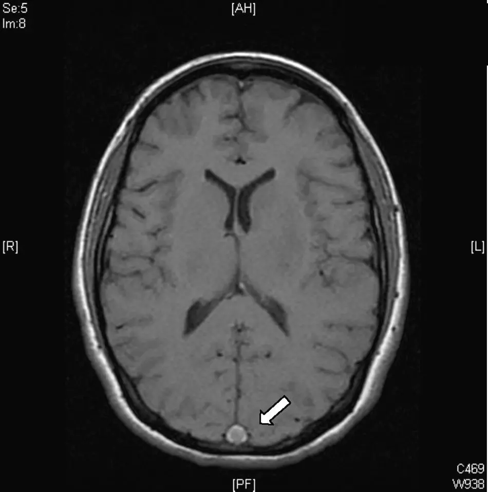 Trombosis del Seno Longitudinal Superior: Una Complicación Grave del Cerebro - Qué hace el seno longitudinal superior trombosis del seno longitudinal superior - Qué hace el seno longitudinal superior