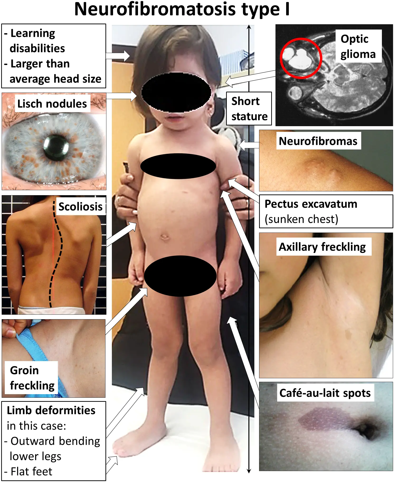 Neurofibroma: Causas, Síntomas y Tratamiento - Qué hace la neurofibromina neurofibroma - Qué hace la neurofibromina