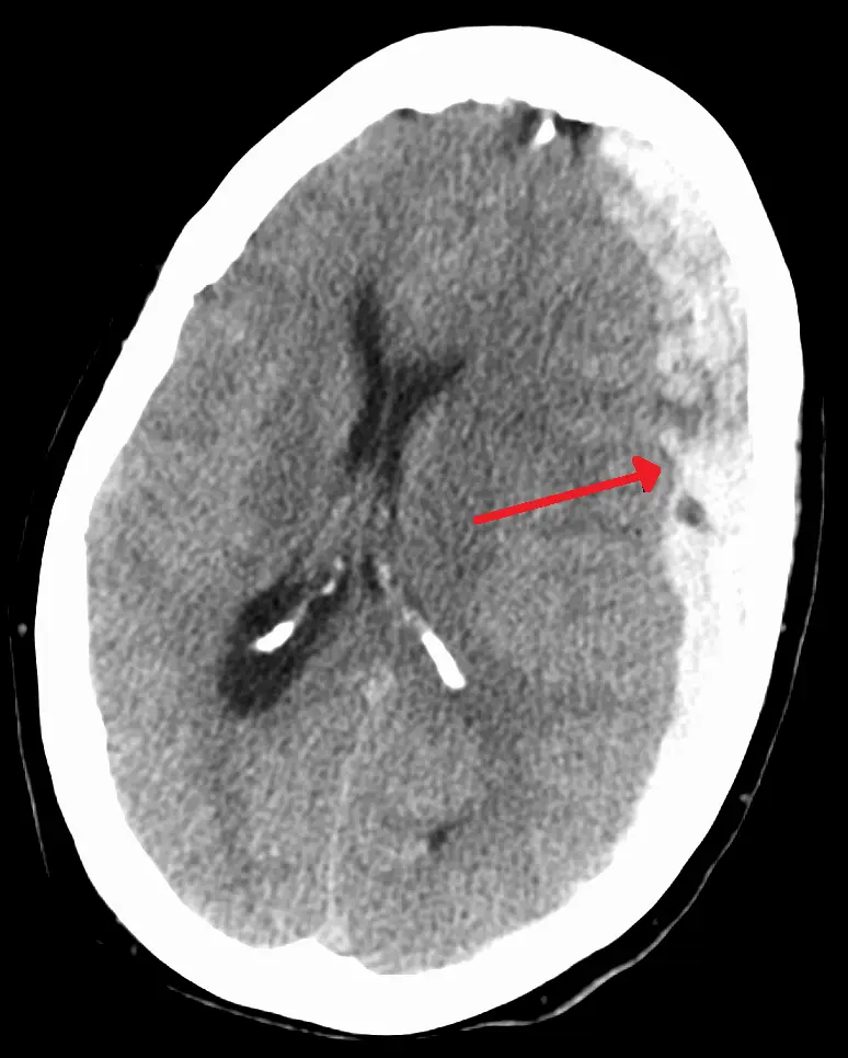 Hematomas subdurales: Causas, síntomas, diagnóstico y tratamiento - Qué hacer ante un hematoma subdural hematoma subdural - Qué hacer ante un hematoma subdural