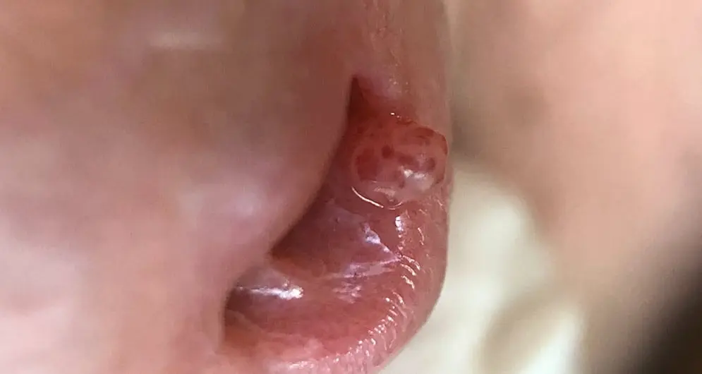 Uretritis: Causas, Síntomas, Tratamiento y Prevención - Qué hacer para desinflamar la uretra uretra inflamada - Qué hacer para desinflamar la uretra
