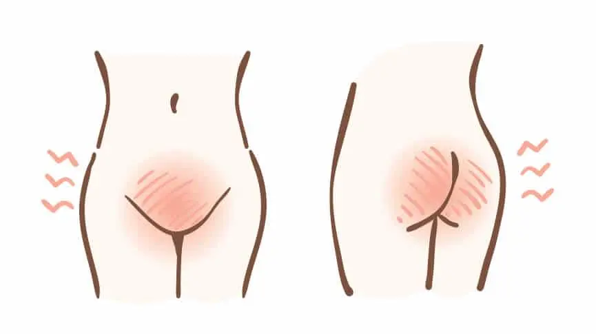 Picazón en la Vulva: Causas, Síntomas y Tratamiento - Qué hacer si tienes picazón en la vulva picazon en la vulva - Qué hacer si tienes picazón en la vulva