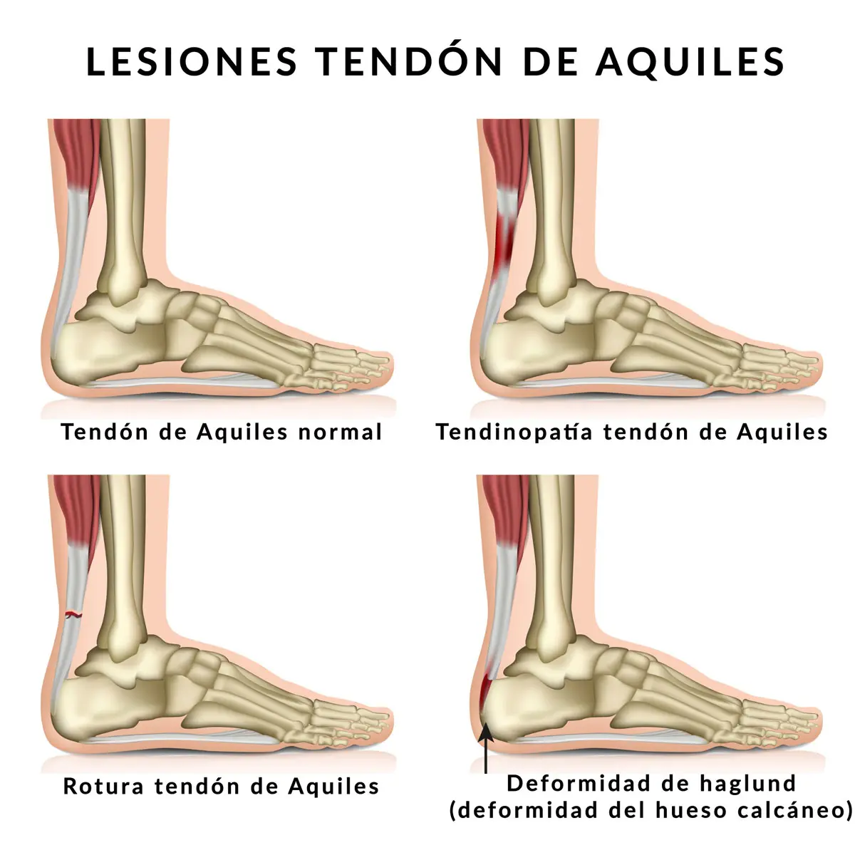 dolor en el tendon de aquiles - Qué hago si me duele el tendón de Aquiles