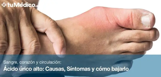 Ácido Úrico Alto: Guía Completa para Reducir los Niveles - Qué hay que hacer para bajar el ácido úrico acido urico alto - Qué hay que hacer para bajar el ácido úrico