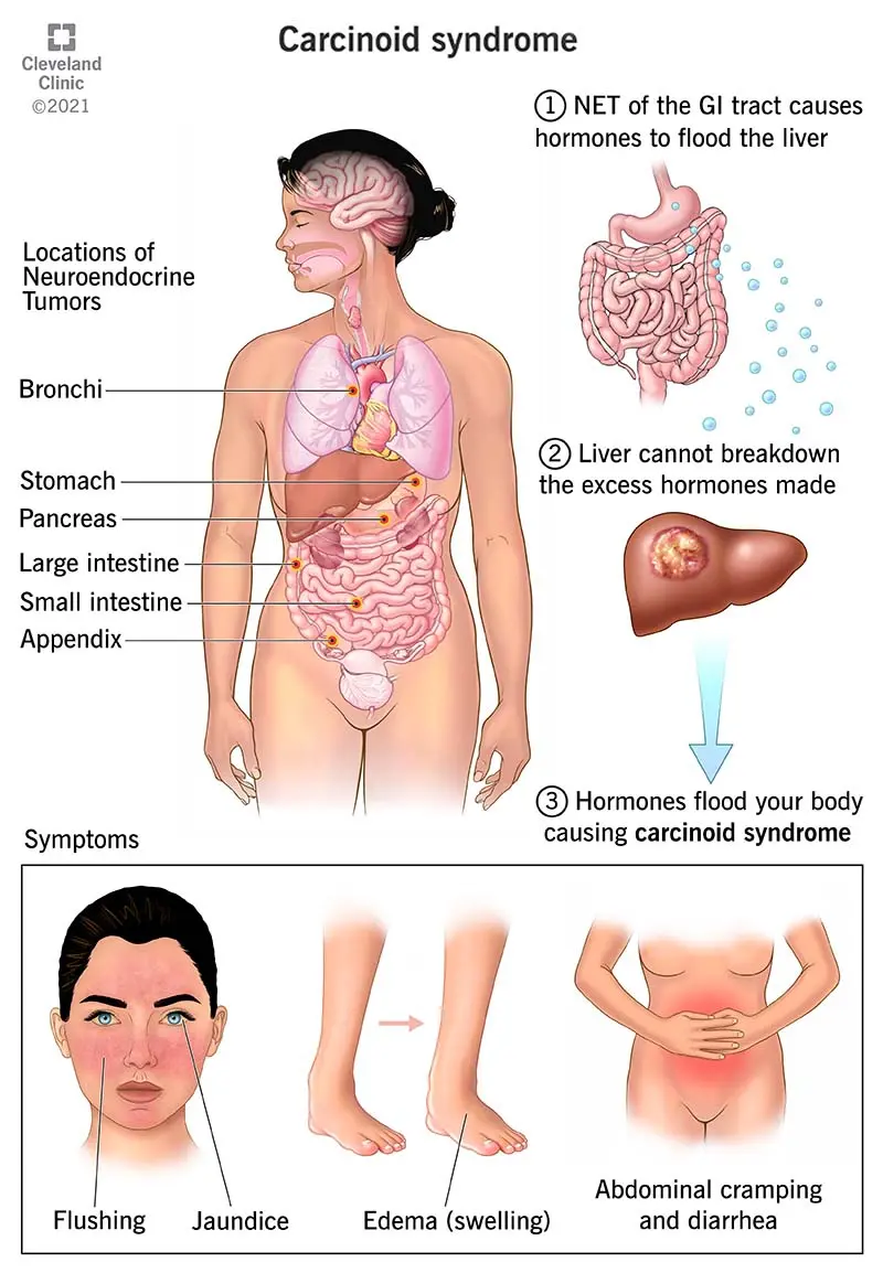 Tumor Carcinoide: Qué es, Síntomas y Tratamiento - Qué hormona produce tumor carcinoide tumor carcinoide - Qué hormona produce tumor carcinoide