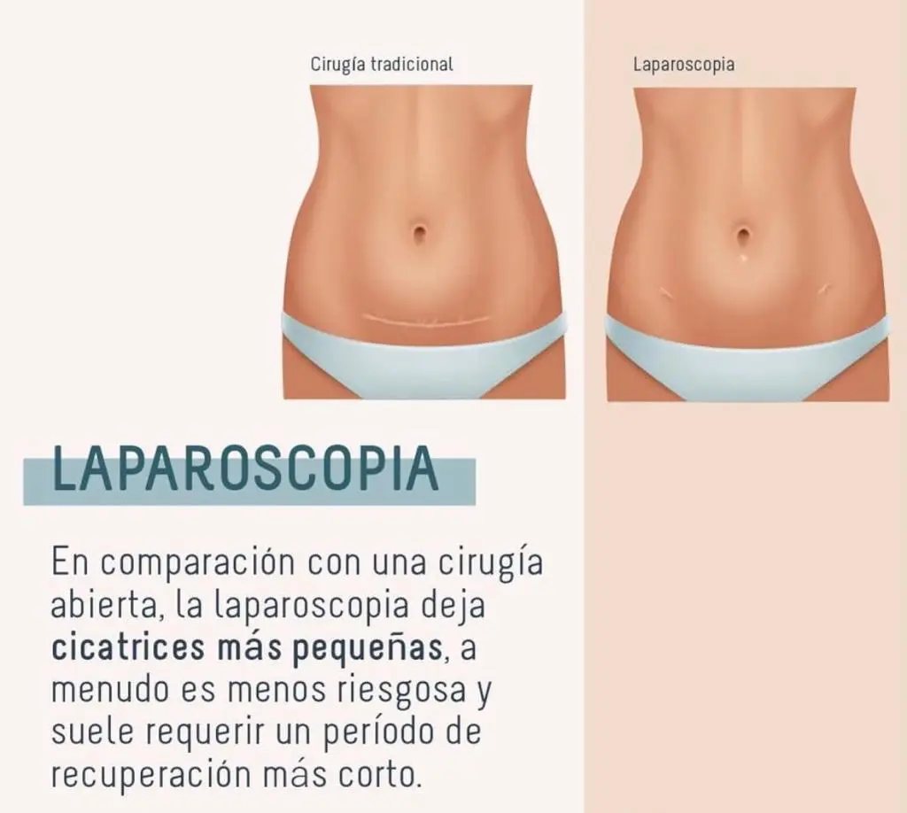 Histerectomía Laparoscópica: Una Guía Completa para Pacientes y Médicos - Qué indicaciones tiene una histerectomía laparoscópica histerectomia por laparoscopia - Qué indicaciones tiene una histerectomía laparoscópica