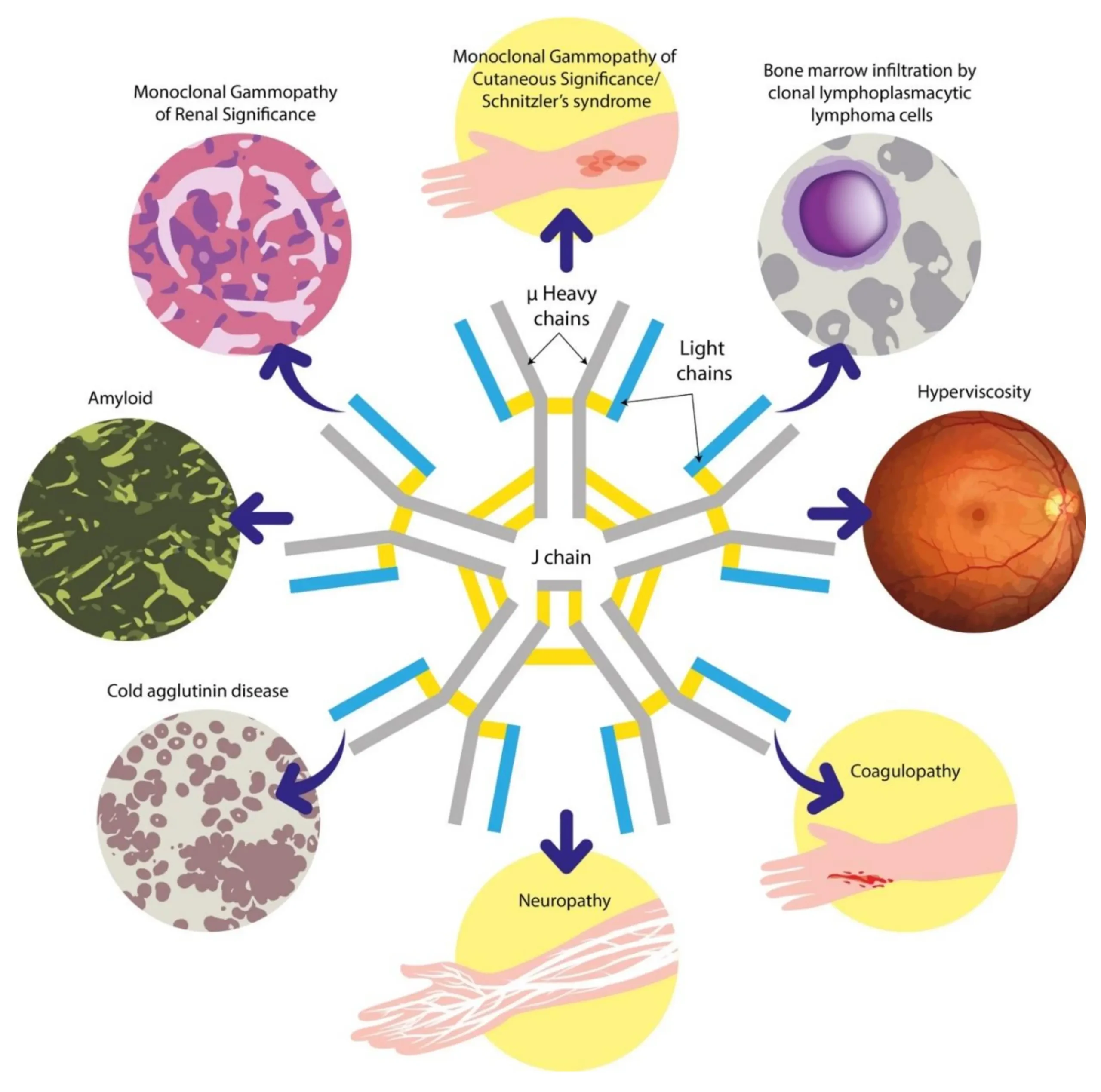 Inmunoglobulina M Alta y su Relación con el Cáncer: Explorando el Papel de la IgM - Qué inmunoglobulina detecta el cáncer inmunoglobulina m alta cancer - Qué inmunoglobulina detecta el cáncer