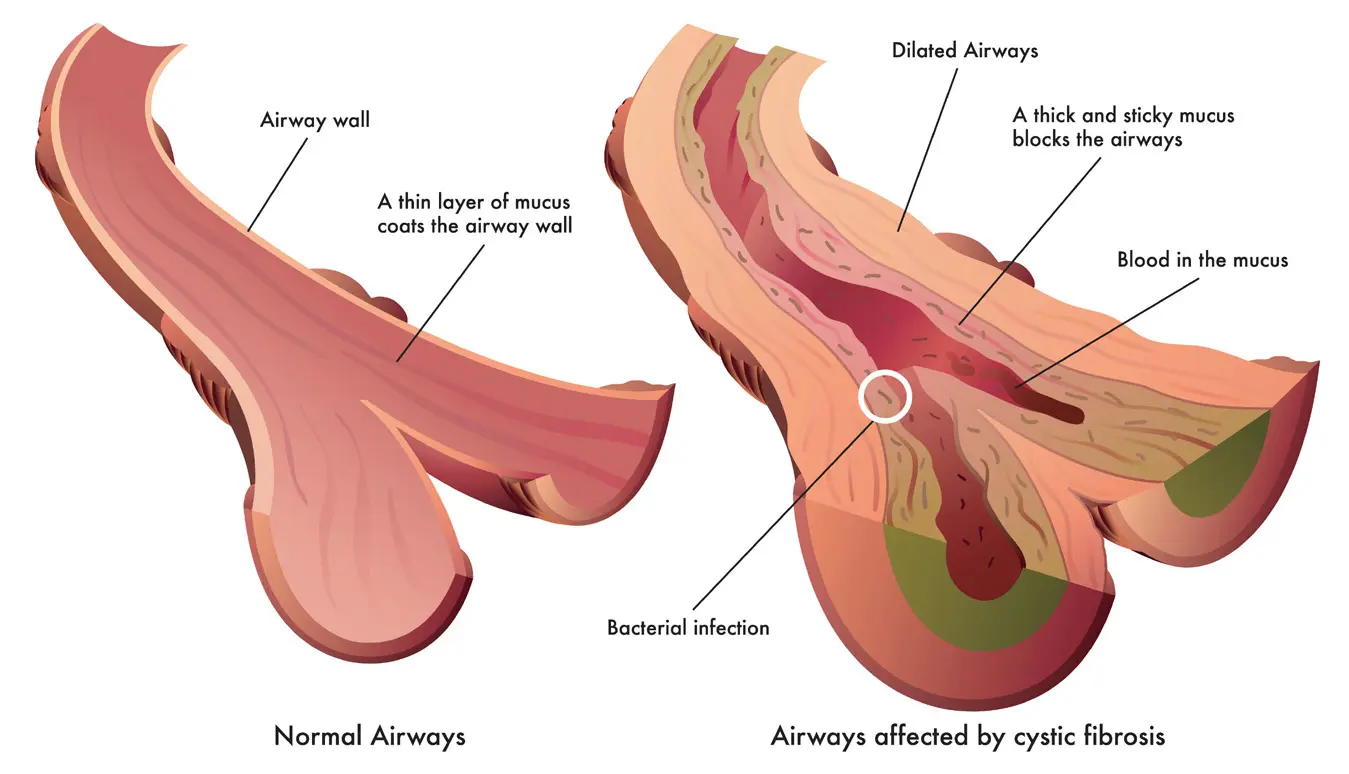 Fibrosis Quística del Páncreas: Complicaciones y Manejo - Qué le sucede al páncreas en la fibrosis quística fibrosis quistica del pancreas - Qué le sucede al páncreas en la fibrosis quística