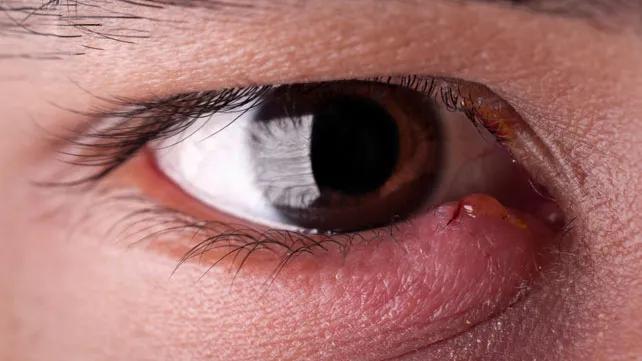 Orzuelo: Síntomas, Causas, Tratamiento y Cuidados - Qué medicamento sirve para quitar un orzuelo tratamientos para orzuelo - Qué medicamento sirve para quitar un orzuelo