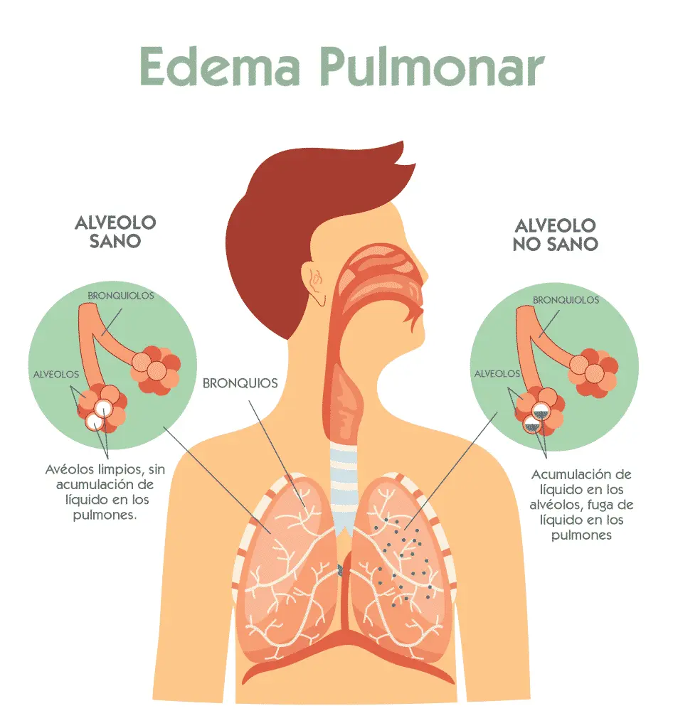 Edema Pulmonar: Causas, Síntomas y Tratamiento - Qué medicamentos pueden causar un edema pulmonar que es un edema pulmonar - Qué medicamentos pueden causar un edema pulmonar