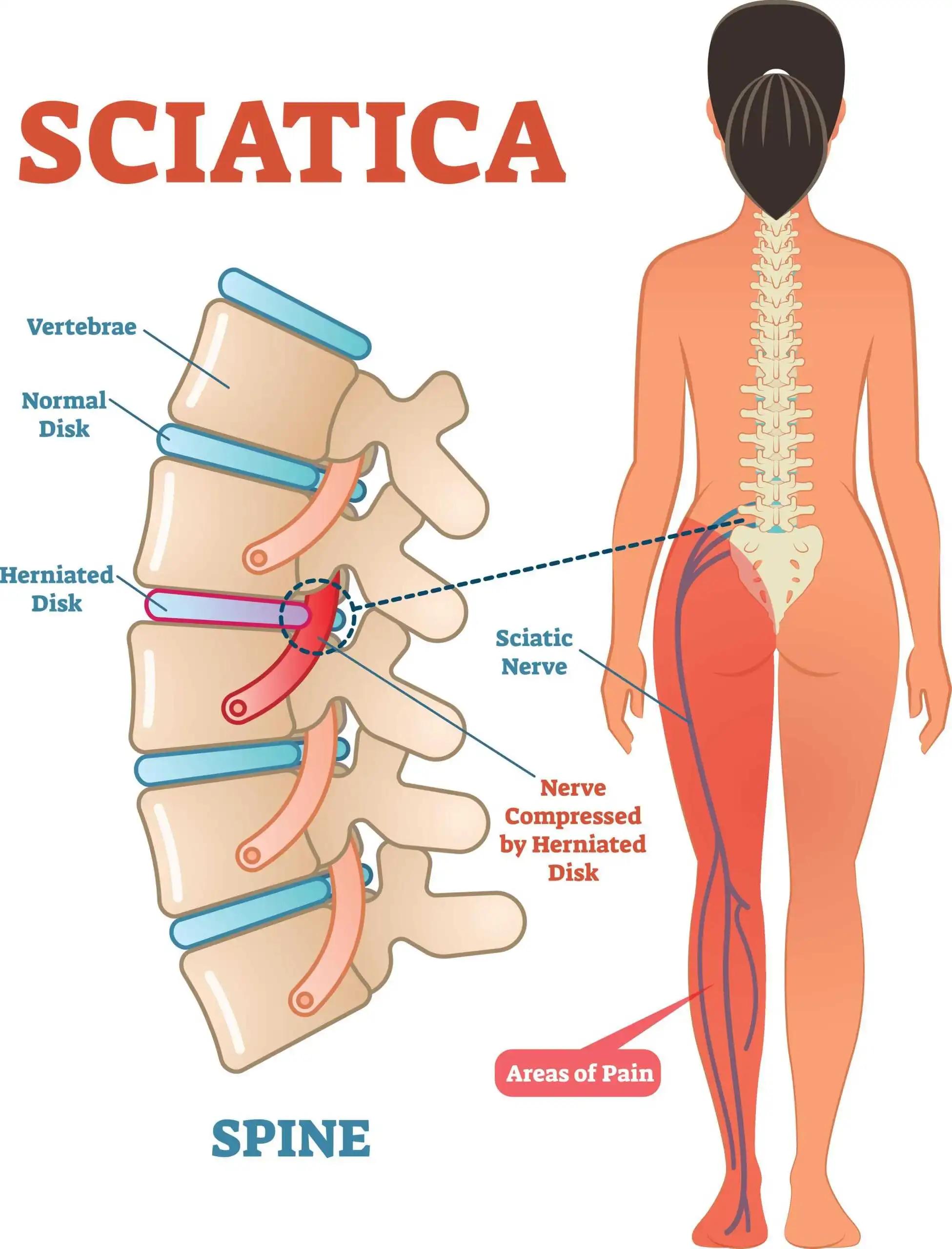 Ciática: ¿Qué médico tratarla y cómo aliviar el dolor? - Qué médico trata el dolor del nervio ciático especialista en ciatica - Qué médico trata el dolor del nervio ciático