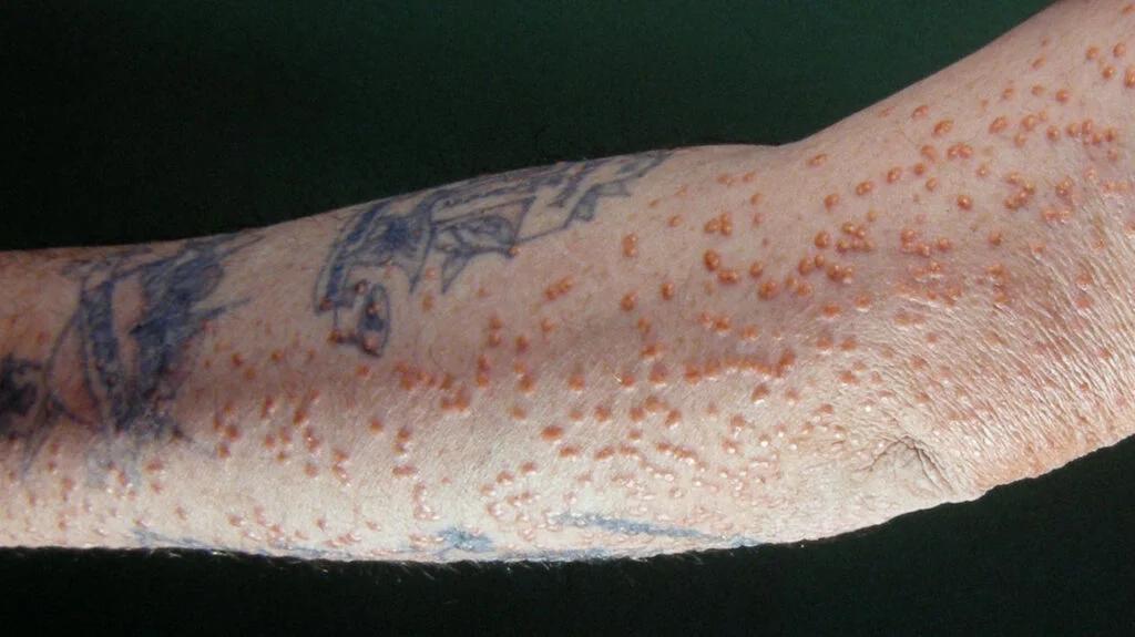 Xantomatosis Eruptiva: Causas, Síntomas y Tratamiento - Qué médico trata los xantomas xantomatosis eruptiva - Qué médico trata los xantomas