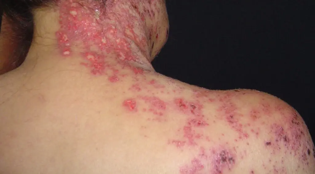Culebrilla en la cabeza: Síntomas, causas y tratamiento - Qué no debo hacer si tengo culebrilla culebrilla en la cabeza - Qué no debo hacer si tengo culebrilla
