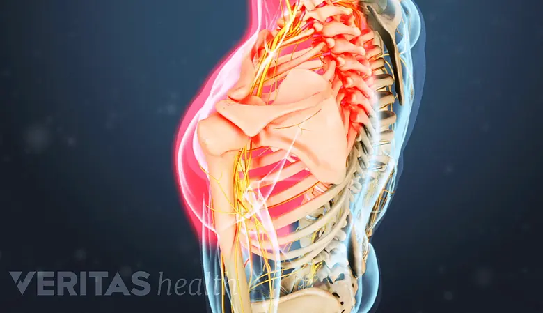 Hernia de Disco Cervical: Síntomas, Causas y Tratamiento - Qué no debo hacer si tengo una hernia cervical hernia de disco cervical sintomas - Qué no debo hacer si tengo una hernia cervical