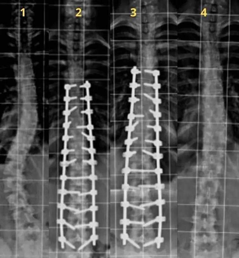 Cirugía de Escoliosis: Riesgos, Procedimientos y Recuperación - Qué no puede hacer una persona operada de escoliosis cirugia escoliosis - Qué no puede hacer una persona operada de escoliosis