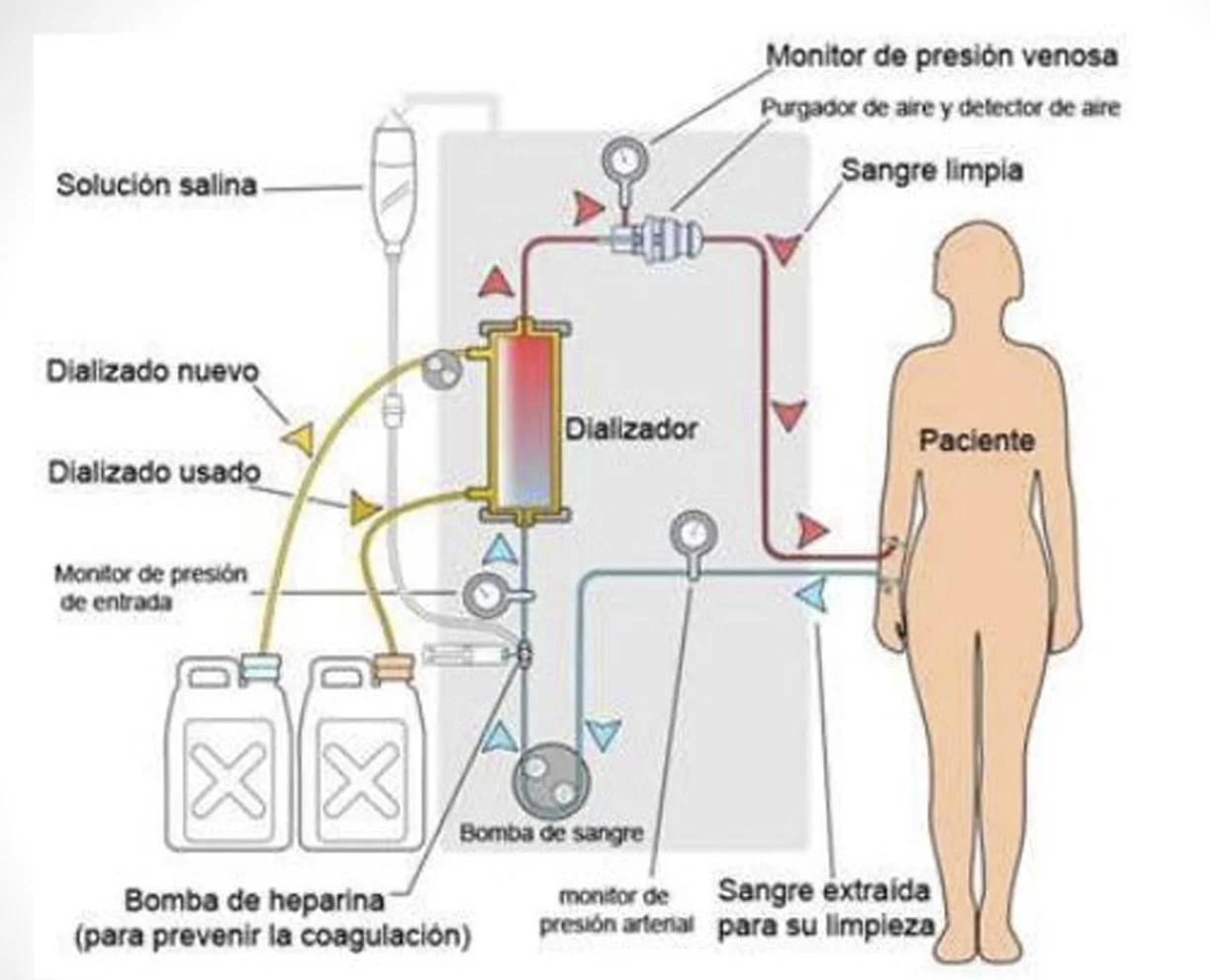 Hemodiálisis: Definición, Procedimiento y Cuidados - Qué pacientes necesitan hemodiálisis hemodialisis definicion - Qué pacientes necesitan hemodiálisis