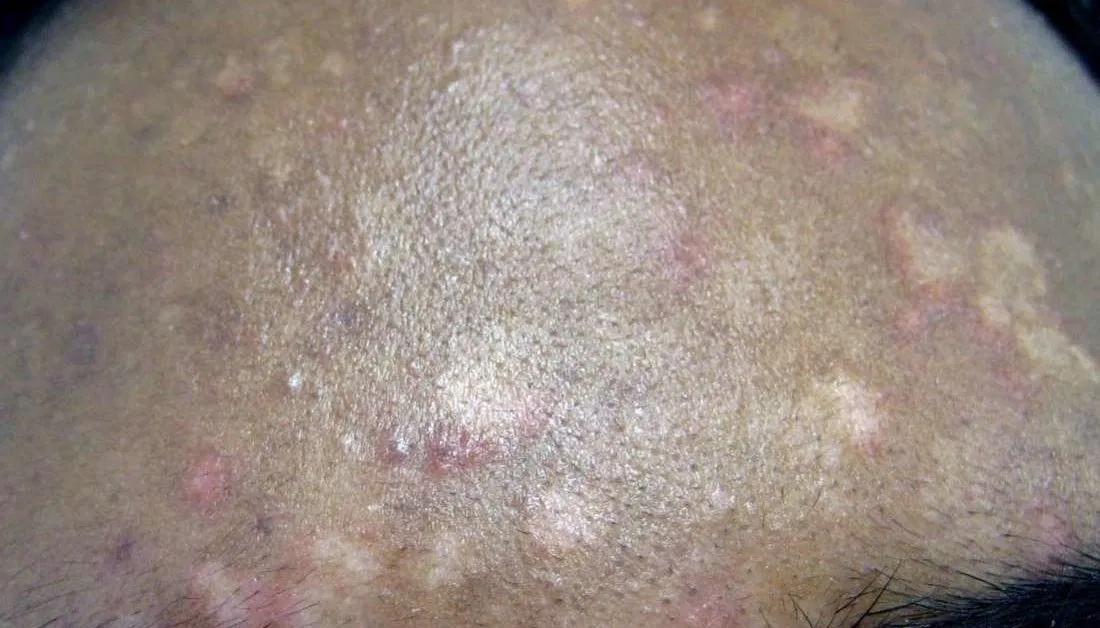 Manchas Blancas en la Piel que Pican: Causas, Tratamiento y Diferencias con el Vitíligo - Qué parásito causa manchas blancas en la piel manchas blancas en la piel que pican - Qué parásito causa manchas blancas en la piel