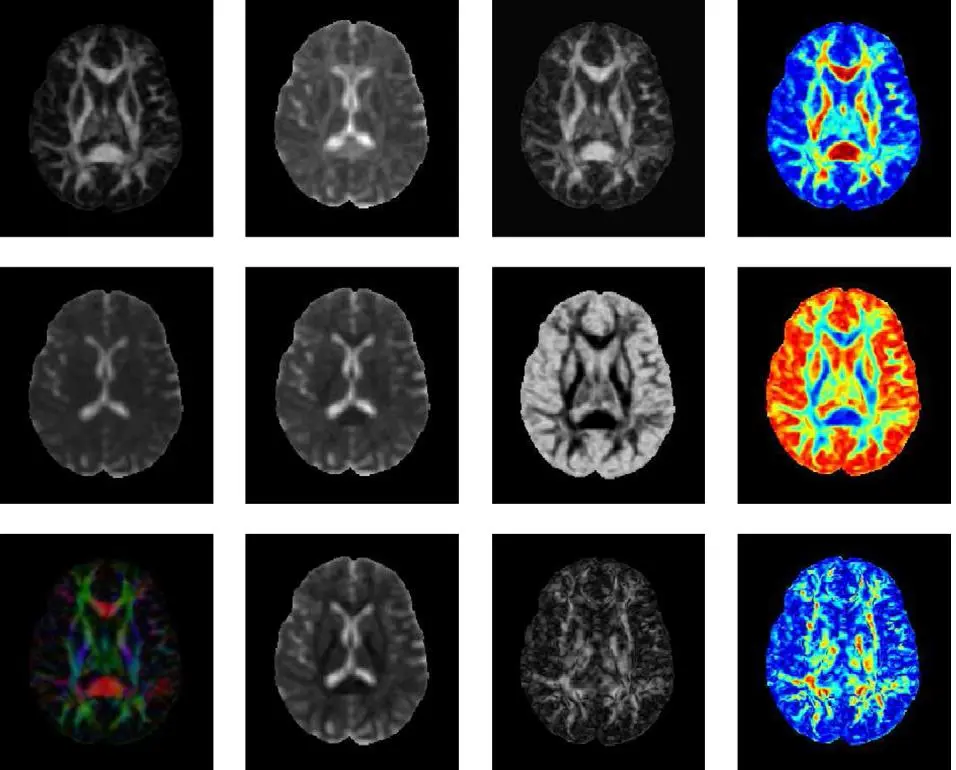 Angiopatía Vascular del Cerebro: Demencia y sus Implicaciones - Qué parte del cerebro afecta la demencia vascular angiopatia vascular del cerebro - Qué parte del cerebro afecta la demencia vascular