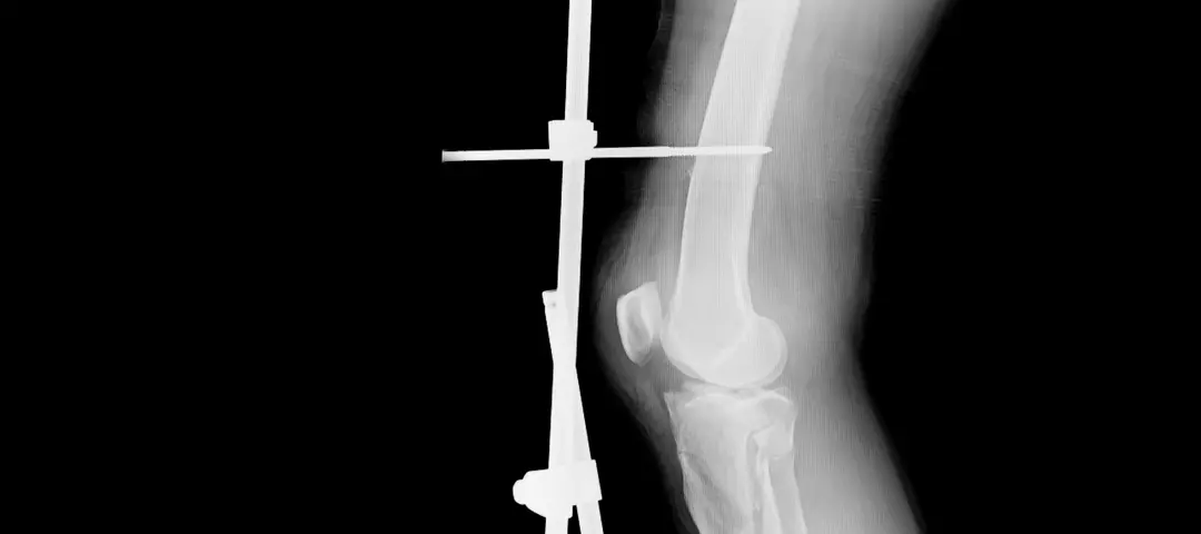 Osteosíntesis: Todo lo que necesitas saber - Qué pasa con los tornillos en los huesos osteosintesis - Qué pasa con los tornillos en los huesos