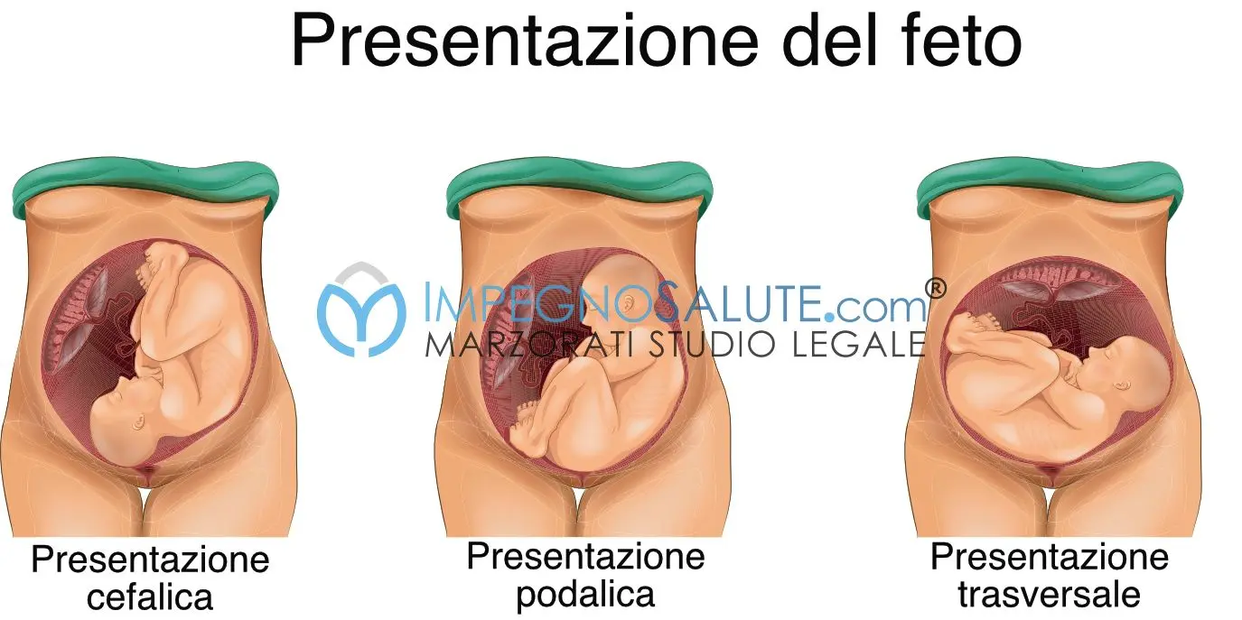 Parto Podálico: ¿Qué Hacer Cuando Tu Bebé Viene Sentado? - Qué pasa cuando el bebé está sentado en el embarazo podalico parto - Qué pasa cuando el bebé está sentado en el embarazo