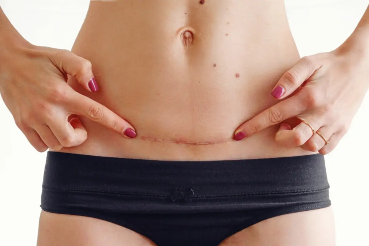 Cicatriz de Cesárea Roja: Causas, Tratamiento y Prevención - Qué pasa cuando la cicatriz se pone roja cicatriz de cesarea roja - Qué pasa cuando la cicatriz se pone roja