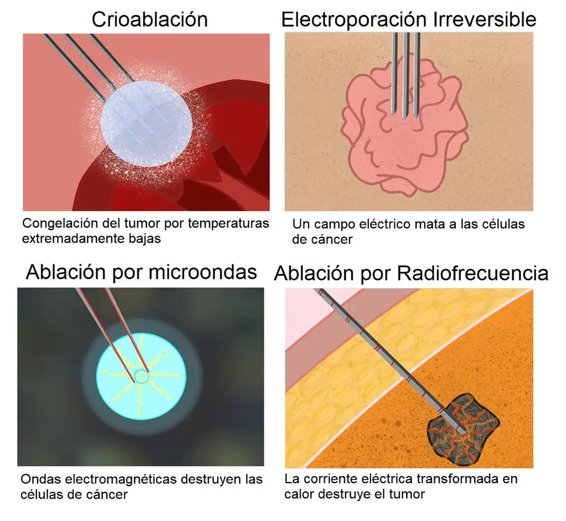 Ablación Cardíaca: Tratamiento para Arritmias - Qué pasa después de una ablación cardíaca ablacion - Qué pasa después de una ablación cardíaca