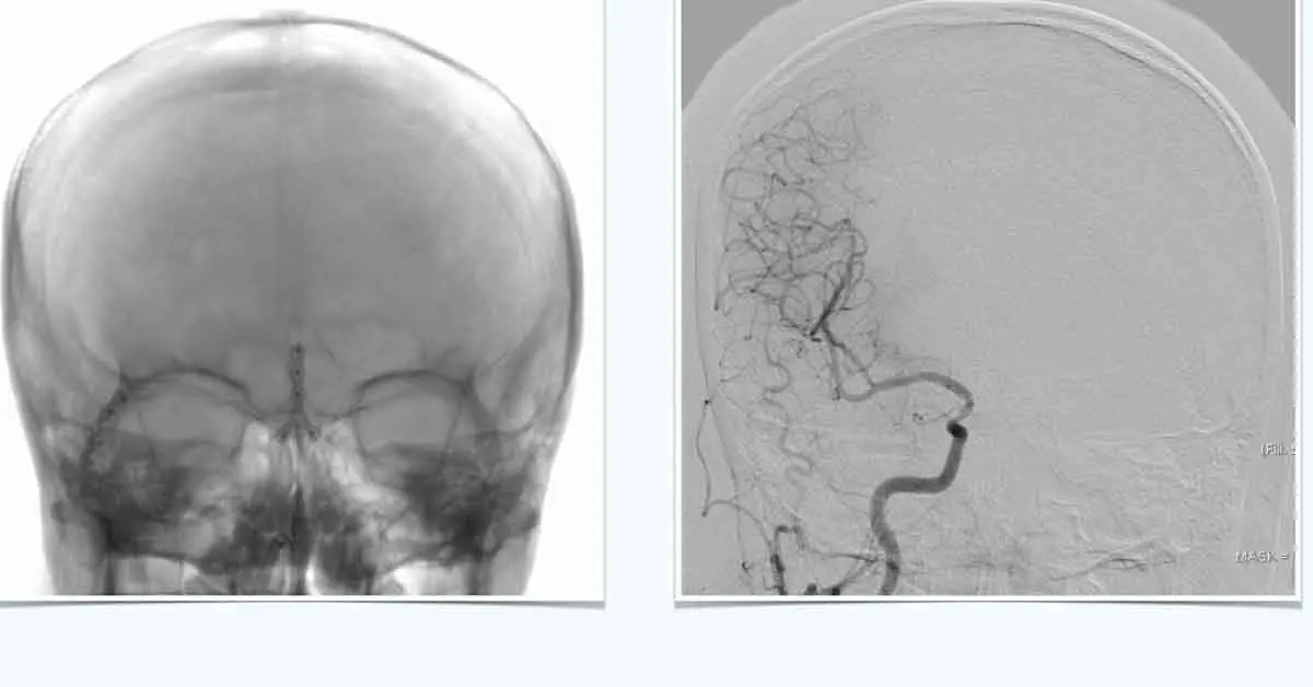 Angiografía: Qué es, cómo se realiza y riesgos asociados - Qué pasa después de una angiografía angiografia - Qué pasa después de una angiografía