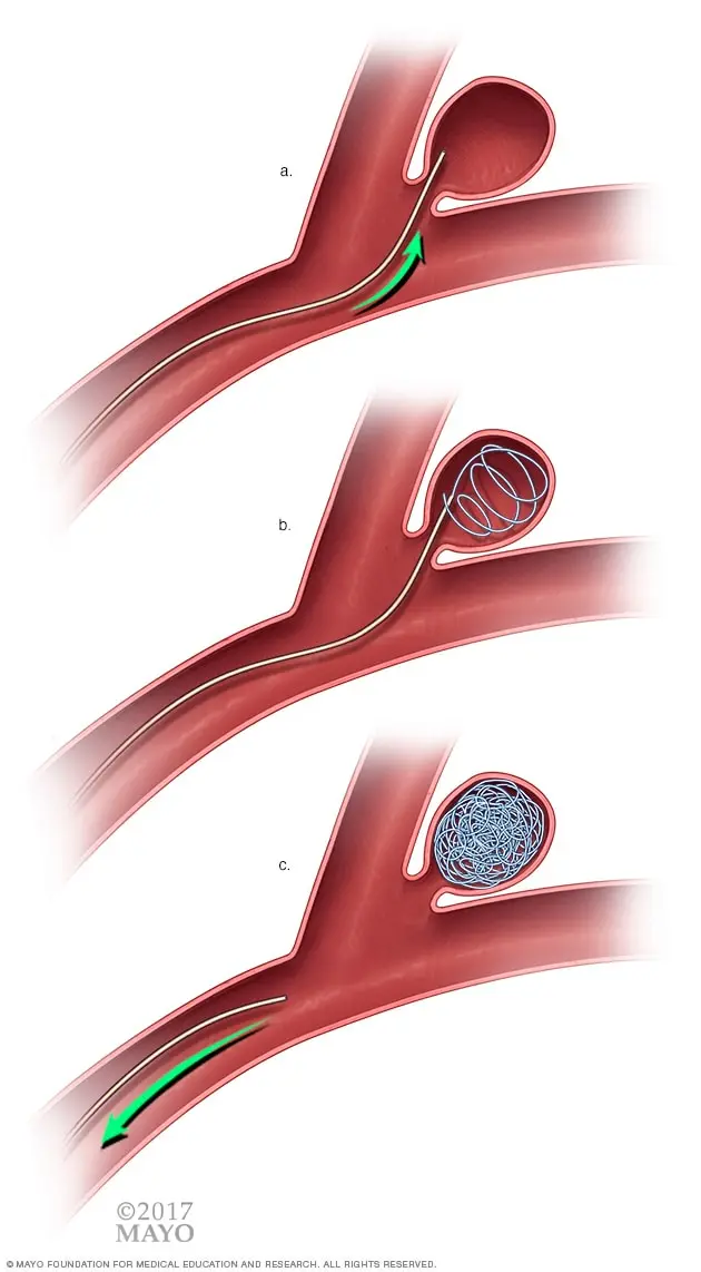 Embolización de Aneurisma Cerebral: Un Procedimiento para Tratar Malformaciones Vasculares - Qué pasa después de una embolización cerebral embolizacion de aneurisma - Qué pasa después de una embolización cerebral
