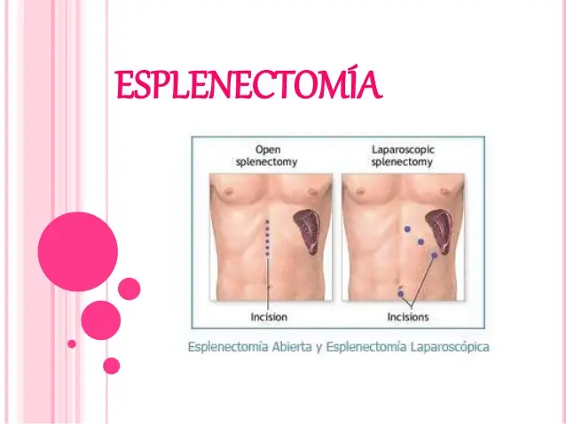 Esplenectomía: Qué es, por qué se realiza y qué esperar - Qué pasa después de una esplenectomía esplenectomia - Qué pasa después de una esplenectomía