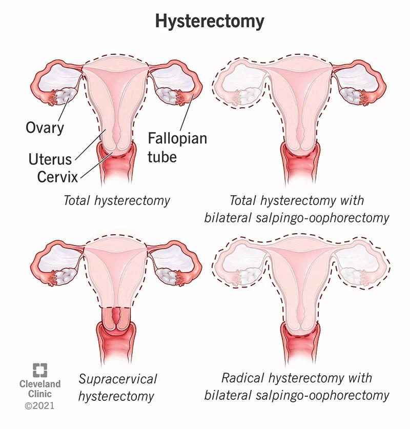 histerectomia radical - Qué pasa después de una histerectomía radical
