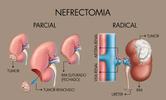 Nefrectomía Radical: Procedimiento, Tipos y Complicaciones - Qué pasa después de una nefrectomía radical nefrectomia radical - Qué pasa después de una nefrectomía radical